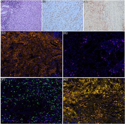 Case Report: Favorable Response and Manageable Toxicity to the Combination of Camrelizumab, Oxaliplatin, and Oral S-1 in a Patient With Advanced Epstein–Barr Virus-Associated Gastric Cancer